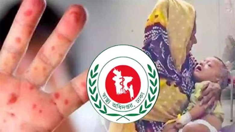দেশে হাম উপসর্গে আরও এক শিশুর মৃত্যু, মোট প্রাণহানি ১২০৫